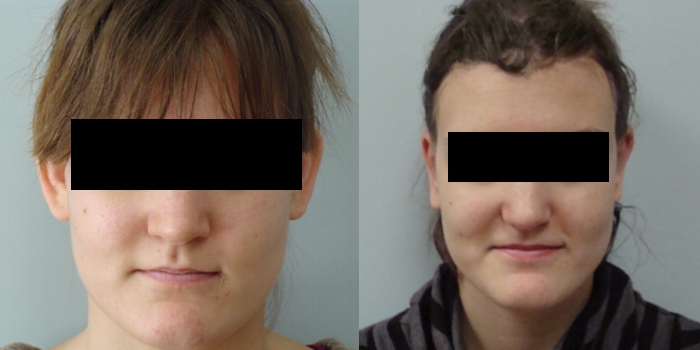 Otoplastika, nakon 7 dana